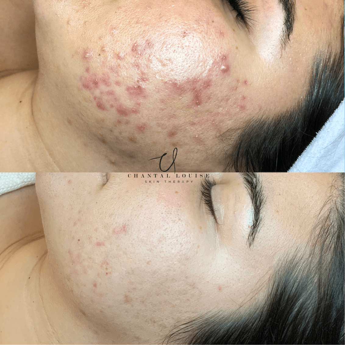 acne before and after treatment