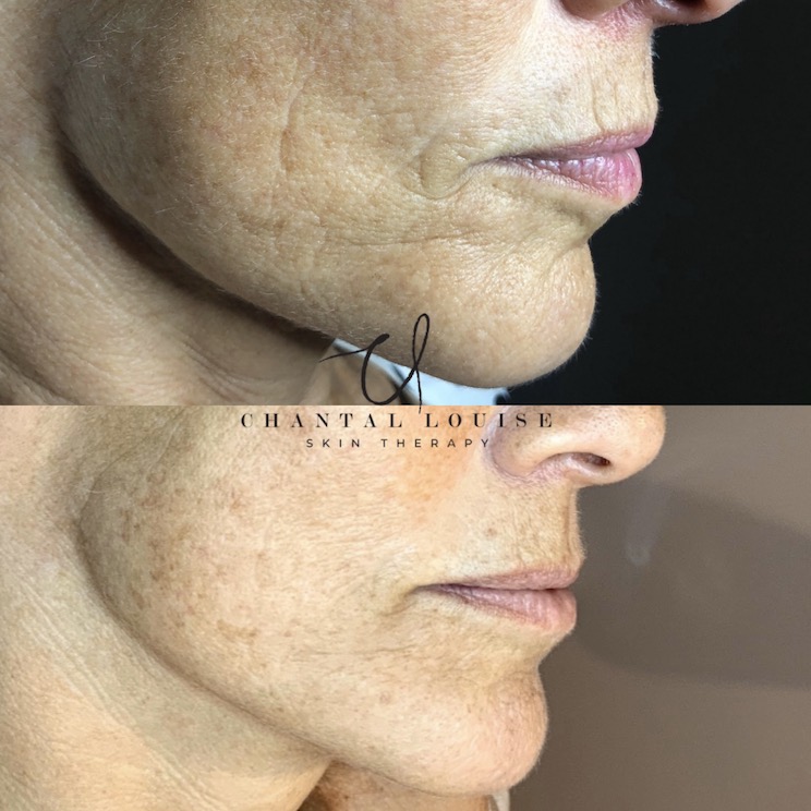 big pores before and after treatment
