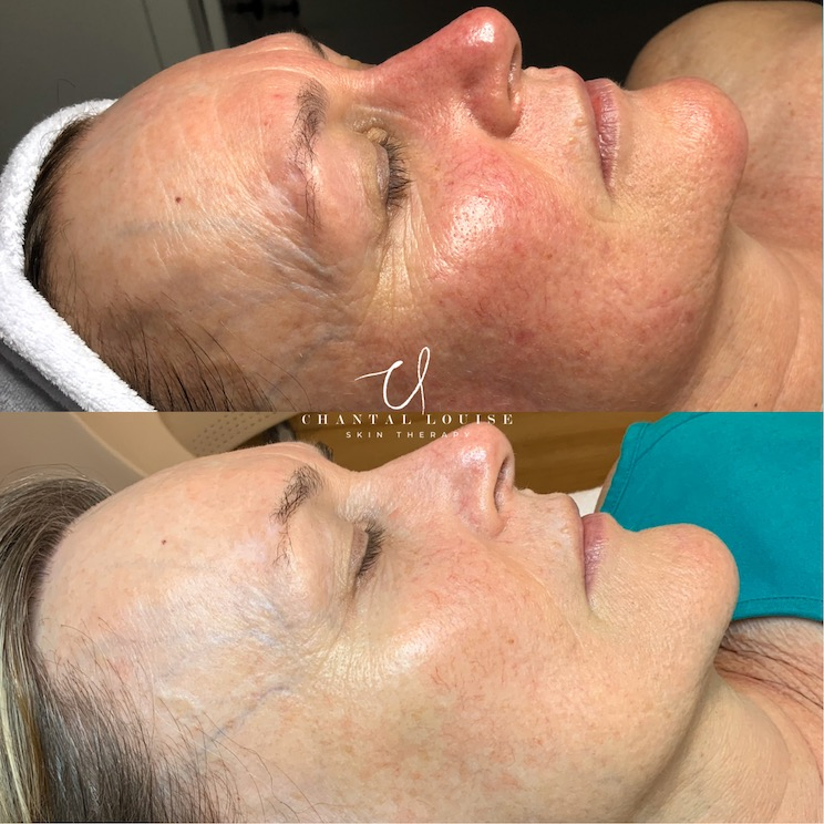 facial treatment before and after